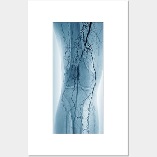 Peripheral vascular disease in diabetes (C029/9941) Posters and Art